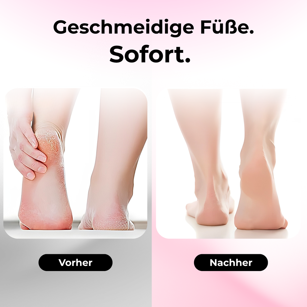 SkinFree™ elektrischer Hornhautentferner